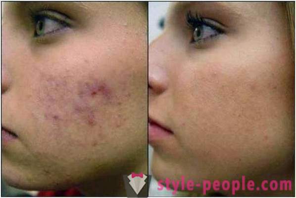 Peeling de ácido azeláico: comentários cosmetologists, fotos antes e depois
