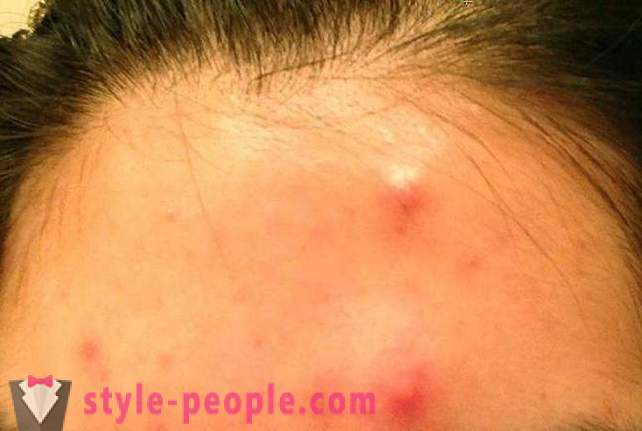 Como para a noite para se livrar da acne em casa?