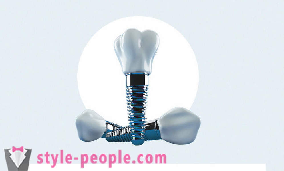 8 perguntas sobre implantes dentários