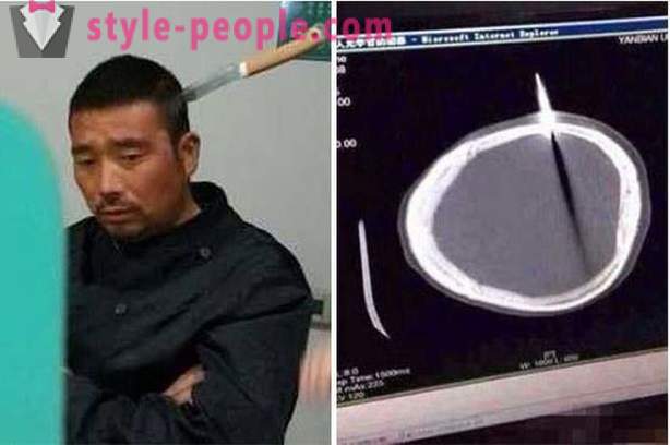 Um homem chinês com uma faca em sua cabeça, ele foi ao médico