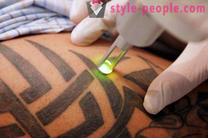 Remoção de tatuagens a laser. Avaliado o