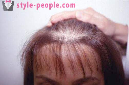 Cabelo Darsonval. darsonvalya aplicação para o tratamento e prevenção de perda de cabelo