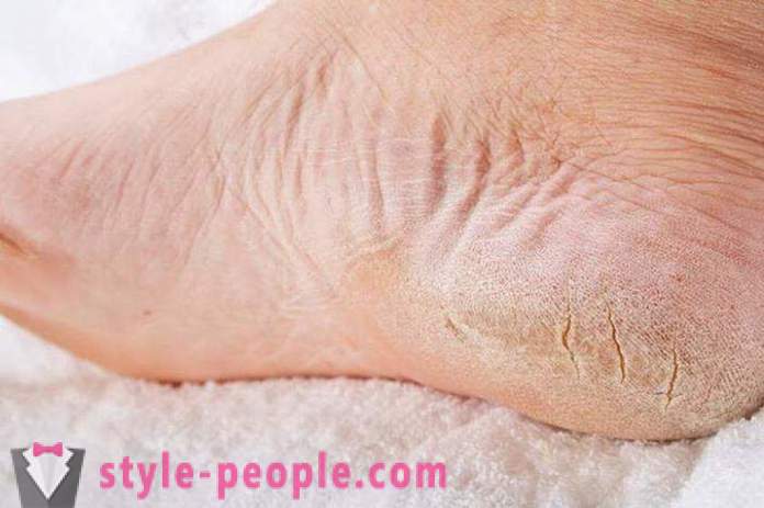 A pele seca em seus pés: Causas