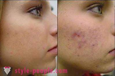 Quer saber como remover os vestígios de espinhas em seu rosto?