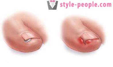 Unha encravada no dedão do pé: Causas e Tratamento
